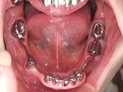リーゲルテレスコープ義歯４