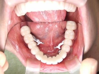 リーゲルテレスコープ義歯５