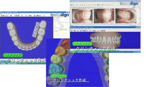 治療シミュレーションソフトで治療後の自分の歯並びの未来を見ることが可能